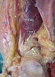 أسباب فشل مفصل الكاحل الصناعي وتآكل العظام