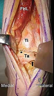 خطوات إزالة المفصل الصناعي التالف وتنظيف العظم