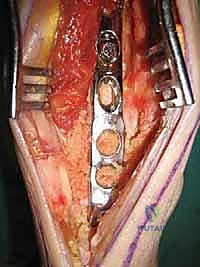 مقارنة الخيارات الجراحية لإنقاذ مفصل الكاحل