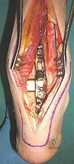 التشخيص الدقيق بالأشعة المقطعية والرنين المغناطيسي لحالات فشل الكاحل