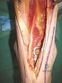 FIG 8 Weight-bearing lateral radiograph 3 months postoperatively