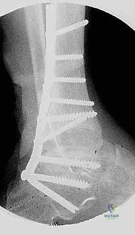 Posterior Blade Plate Arthrodesis for Failed Total Ankle Arthroplasty: An Intraoperative Masterclass