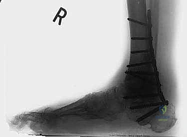 FIG 8 Weight-bearing lateral radiograph 3 months postoperatively