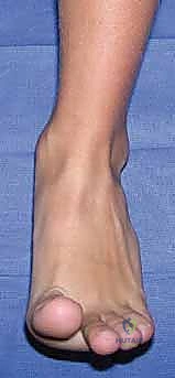 منظار الكاحل: دليل شامل للعلاج الدقيق لمفصل القدم مع الأستاذ الدكتور محمد هطيف في صنعاء