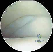 صورة طبية: منظار الكاحل: دليل شامل للعلاج الدقيق لمفصل القدم مع الأستاذ الدكتور محمد هطيف في صنعاء