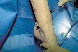 صورة طبية: منظار الكاحل: دليل شامل للعلاج الدقيق لمفصل القدم مع الأستاذ الدكتور محمد هطيف في صنعاء