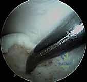 صورة طبية: منظار الكاحل: دليل شامل للعلاج الدقيق لمفصل القدم مع الأستاذ الدكتور محمد هطيف في صنعاء