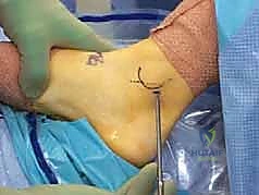 صورة طبية: منظار الكاحل: دليل شامل للعلاج الدقيق لمفصل القدم مع الأستاذ الدكتور محمد هطيف في صنعاء