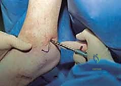 صورة طبية: منظار الكاحل: دليل شامل للعلاج الدقيق لمفصل القدم مع الأستاذ الدكتور محمد هطيف في صنعاء