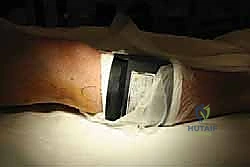 صورة توضيحية لـ منظار الكاحل: دليل شامل للعلاج الدقيق لمفصل القدم مع الأستاذ الدكتور محمد هطيف في صنعاء