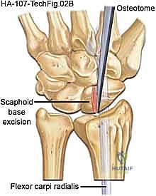 النهج الجراحي الظهري للرسغ وحماية الأنسجة