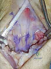 صورة توضيحية لـ استئصال الصف القريب من عظام الرسغ: حل متقدم لآلام المعصم المزمنة وتآكل المفاصل