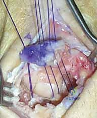 صورة توضيحية لـ استئصال الصف القريب من عظام الرسغ: حل متقدم لآلام المعصم المزمنة وتآكل المفاصل