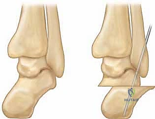 أعراض القدم الجوفاء وعدم الاستقرار