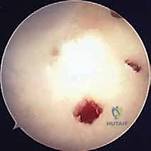 Surgical technique step for Microfracture for Osteochondral Lesions of the Talus