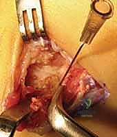 الخيارات التحفظية لعلاج آلام القدم المسطحة