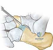 خطوات الاستئصال الجراحي للالتصاق بين العقب والزورقي