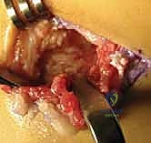 التخطيط الجراحي لإزالة الالتصاق العظمي