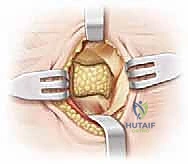 صورة توضيحية لـ الالتصاق العظمي بين العقب والعظم الزورقي فهم شامل وعلاج دقيق للقدم المسطحة الصلبة مع الأستاذ الدكتور محمد هطيف