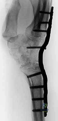 الأستاذ الدكتور محمد هطيف أثناء التخطيط الجراحي الدقيق لعملية تثبيت الرسغ