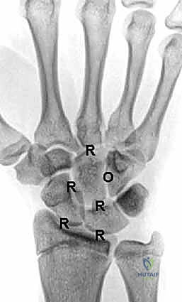 تشريح مفصل الرسغ المعقد وتأثير الالتهاب المزمن عليه