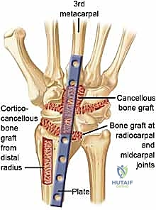 الأشعة السينية توضح التآكل الشديد في مفصل الرسغ قبل الجراحة
