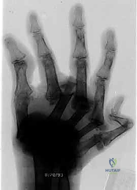 صورة توضيحية لـ تثبيت مفصل الرسغ الكلي: دليل شامل لعلاج التهاب الرسغ المزمن في صنعاء مع الأستاذ الدكتور محمد هطيف