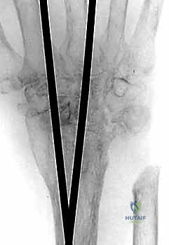متابعة التئام العظام بعد الجراحة عبر الأشعة الدورية