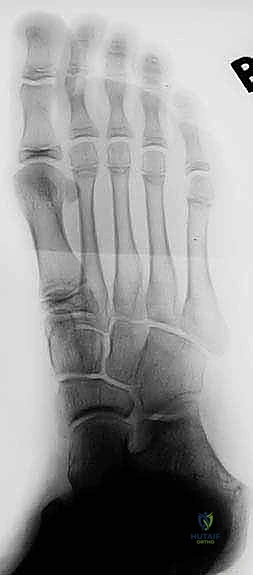 الأعراض السريرية للقدم المسطحة التشنجية