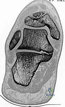 خيارات العلاج التحفظي والأحذية الطبية الداعمة