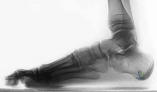 التصوير المقطعي المحوسب لتشخيص الائتلاف