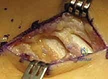 صورة توضيحية لـ جراحة إزالة ائتلاف الكاحل العقبي ورأب المفصل بالترقيع دليل شامل للمرضى مع الأستاذ الدكتور محمد هطيف