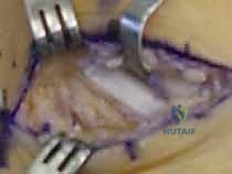 صورة توضيحية لـ جراحة إزالة ائتلاف الكاحل العقبي ورأب المفصل بالترقيع دليل شامل للمرضى مع الأستاذ الدكتور محمد هطيف