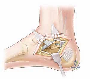 صورة توضيحية لـ جراحة إزالة ائتلاف الكاحل العقبي ورأب المفصل بالترقيع دليل شامل للمرضى مع الأستاذ الدكتور محمد هطيف