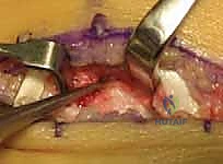 صورة توضيحية لـ جراحة إزالة ائتلاف الكاحل العقبي ورأب المفصل بالترقيع دليل شامل للمرضى مع الأستاذ الدكتور محمد هطيف