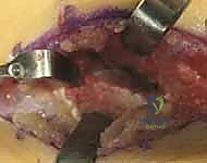 صورة توضيحية لـ جراحة إزالة ائتلاف الكاحل العقبي ورأب المفصل بالترقيع دليل شامل للمرضى مع الأستاذ الدكتور محمد هطيف