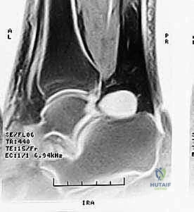 تصوير شعاعي يوضح العظم المثلثي وانحشار الكاحل الخلفي