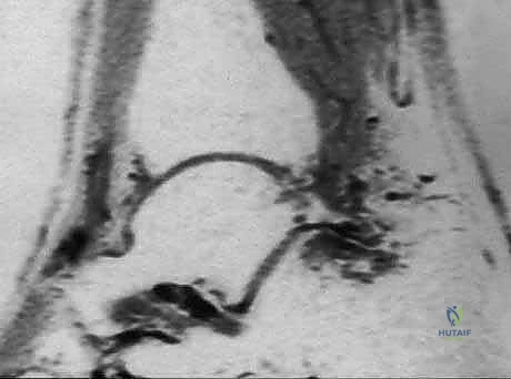 حقن الكاحل الموجه بالأمواج فوق الصوتية كعلاج تحفظي