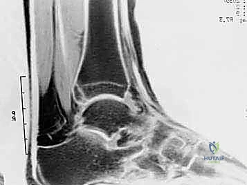 صورة رنين مغناطيسي تظهر التهاب الأنسجة الرخوة في متلازمة انحشار الكاحل