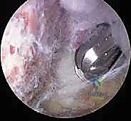 Gusillo–Anderson classification system of open fractures