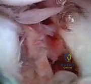 مقارنة الجراحة المفتوحة مقابل المنظار