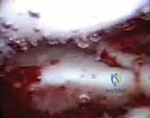 تنظير مفصل الرسغ لتثبيت كسور الكعبرة البعيدة والزند الإبري: دليل شامل للمرضى مع الأستاذ الدكتور محمد هطيف