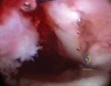صورة توضيحية لـ تنظير مفصل الرسغ لتثبيت كسور الكعبرة البعيدة والزند الإبري: دليل شامل للمرضى مع الأستاذ الدكتور محمد هطيف