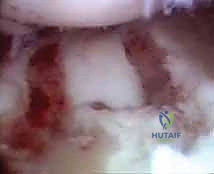تثبيت كسور الرسغ بالمنظار