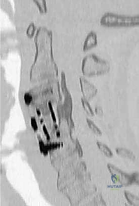 عملية رأب الصفيحة العنقية مع الدكتور محمد هطيف