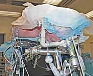 صورة شعاعية توضح تضيق القناة الشوكية