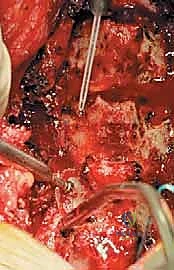 صورة توضيحية لـ رأب الصفيحة العنقية في صنعاء دليل شامل لفك ضغط العمود الفقري واستعادة الحركة مع الأستاذ الدكتور محمد هطيف