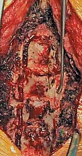 صورة توضيحية لـ رأب الصفيحة العنقية في صنعاء دليل شامل لفك ضغط العمود الفقري واستعادة الحركة مع الأستاذ الدكتور محمد هطيف