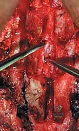 رأب الصفيحة العنقية في صنعاء دليل شامل لفك ضغط العمود الفقري واستعادة الحركة مع الأستاذ الدكتور محمد هطيف