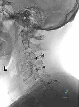 صورة توضيحية لـ رأب الصفيحة العنقية في صنعاء دليل شامل لفك ضغط العمود الفقري واستعادة الحركة مع الأستاذ الدكتور محمد هطيف